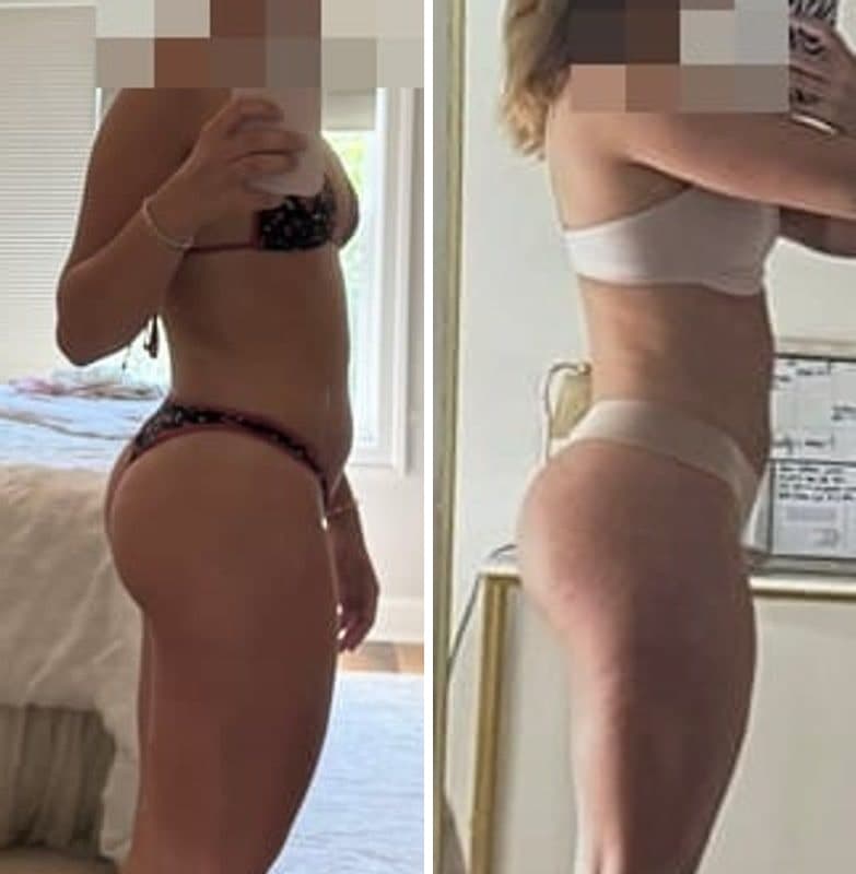 Client before and after, 5 months · no surgery